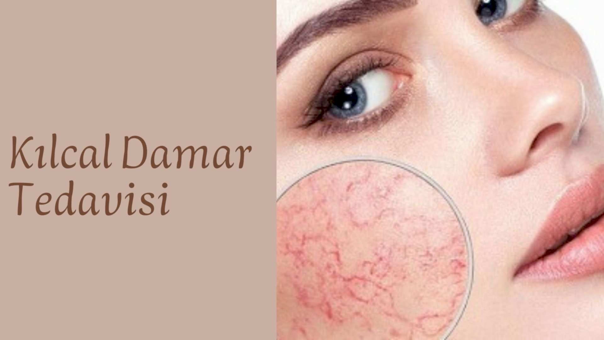 ankara kilcal damar tedavisi