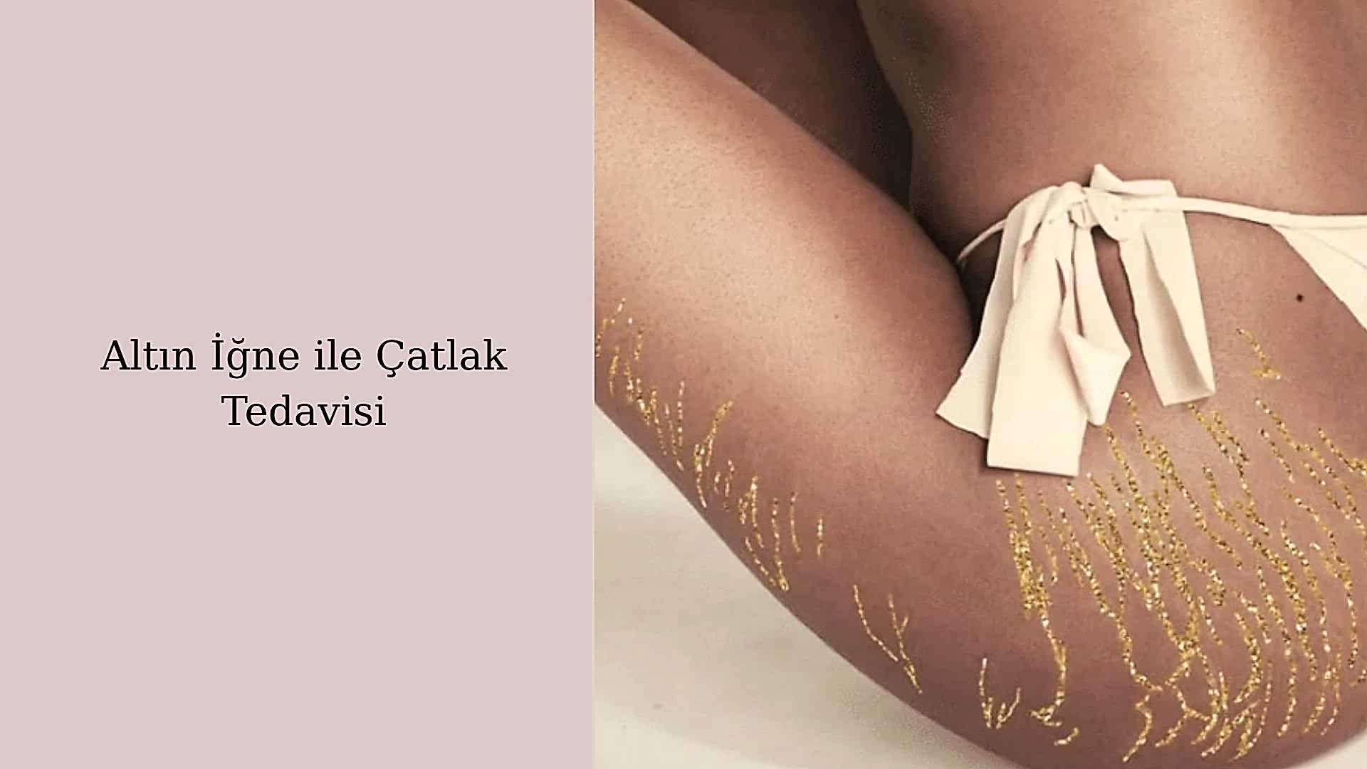 ankara altin igne catlak tedavisi
