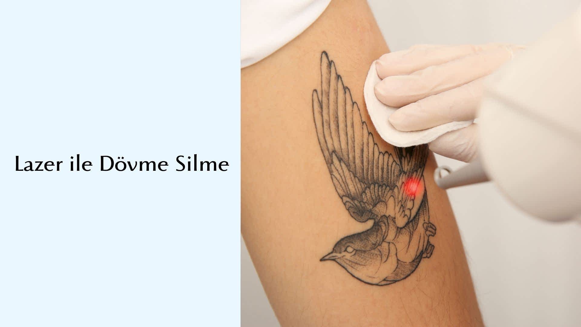 Lazer İle Dövme Silme