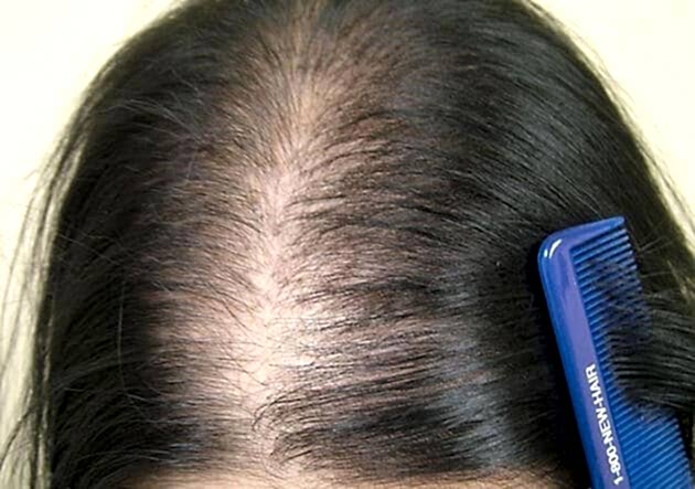 Kadın Tipi Saç Dökülmesi (Androjenik Alopesi) Nedir ve Nasıl Tedavi Edilir?