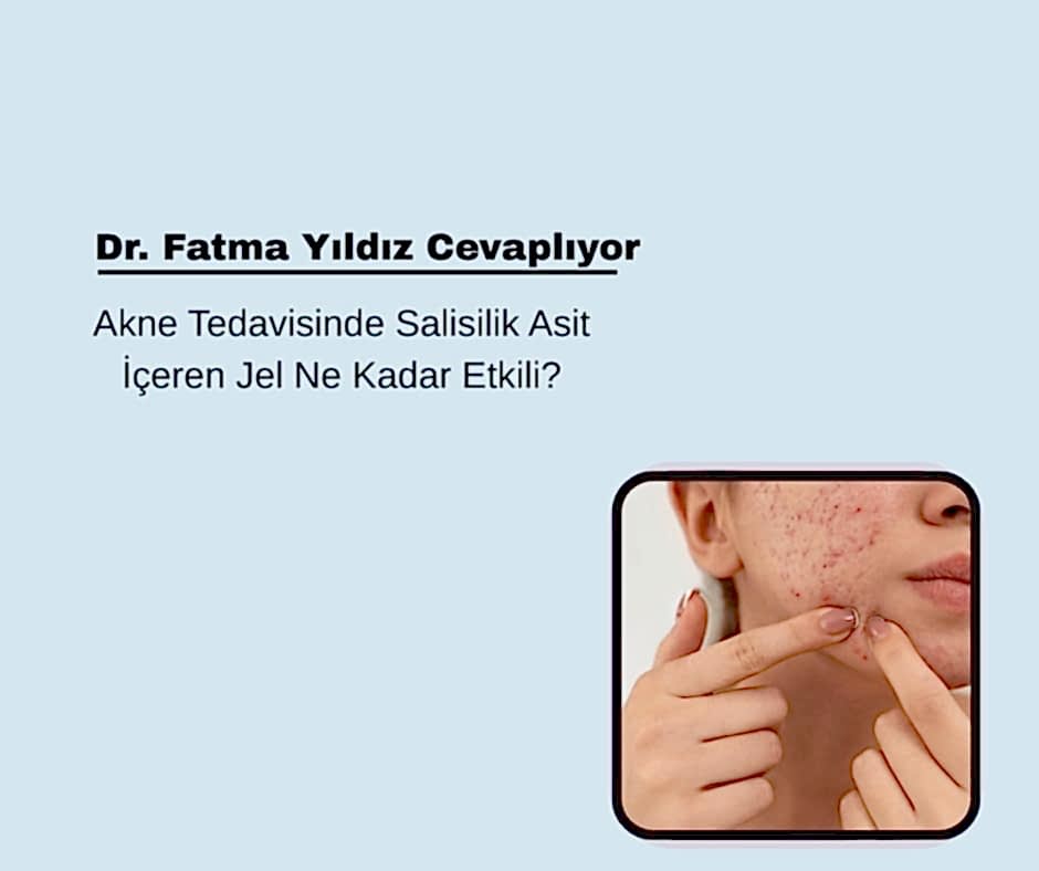 Akne Tedavisinde Salisilik Asit İçeren Jel Ne Kadar Etkili?