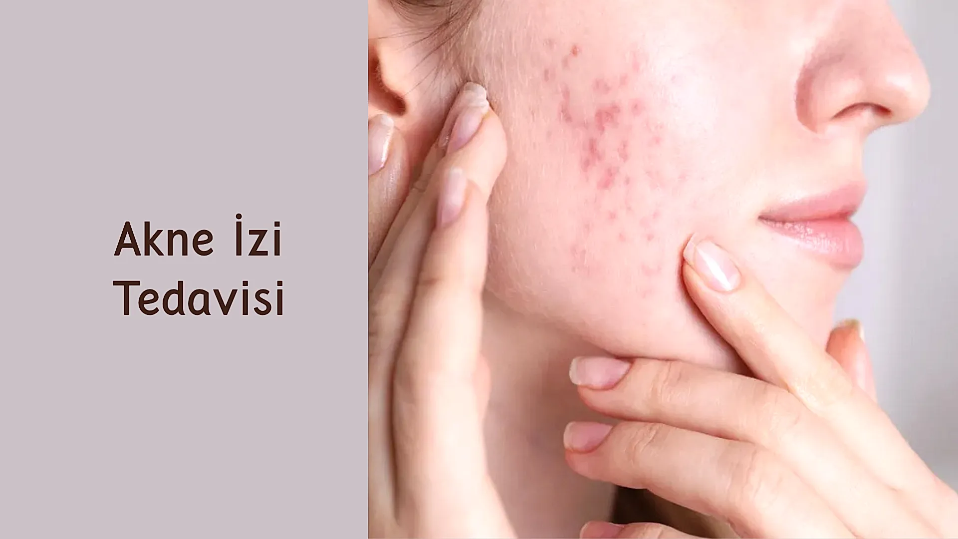 Akne İzi Tedavisi