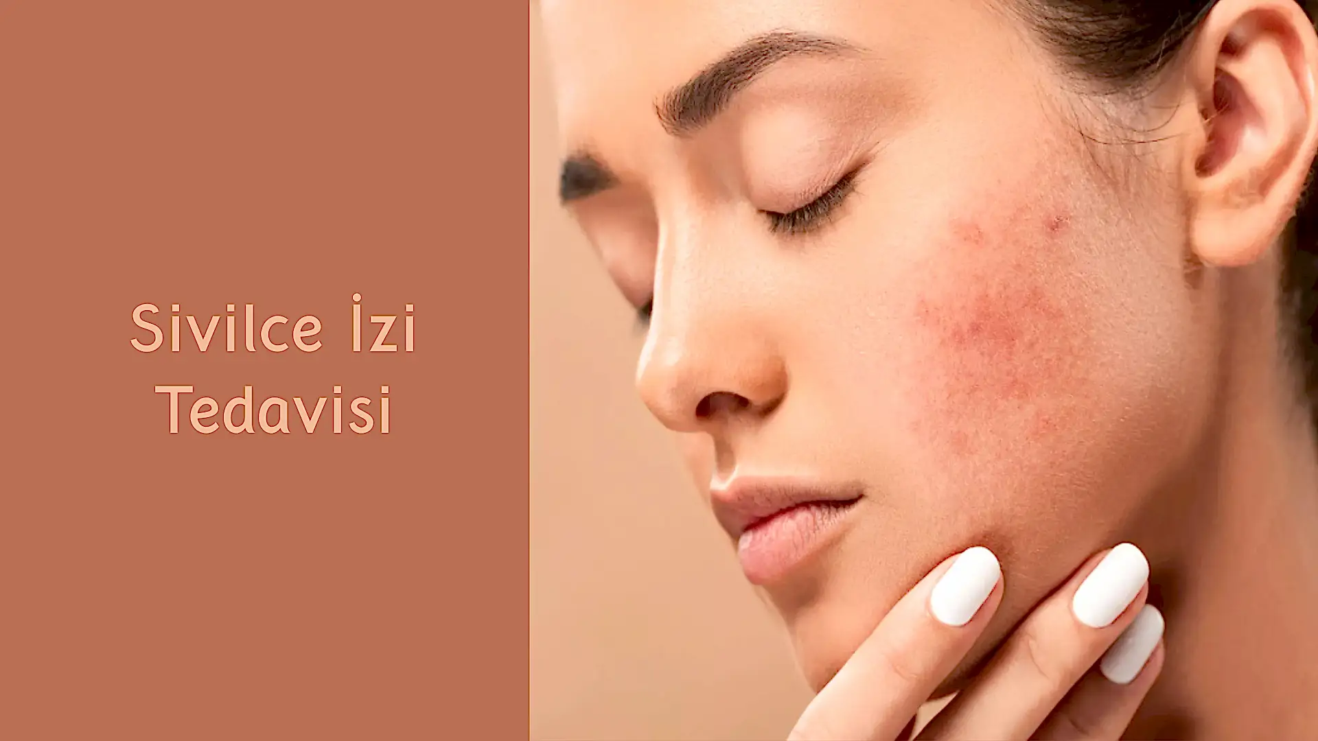 Sivilce İzi Tedavisi
