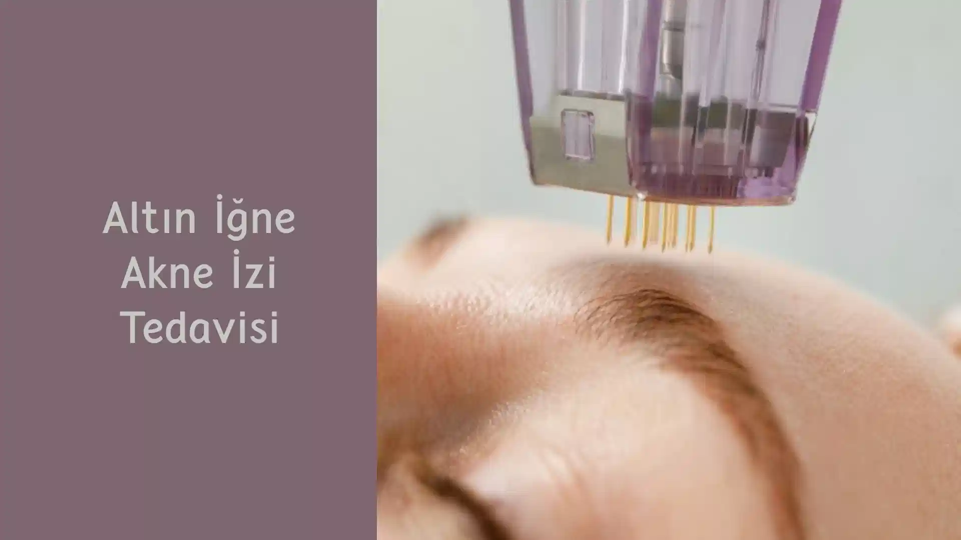 ankara altin igne akne izi tedavisi