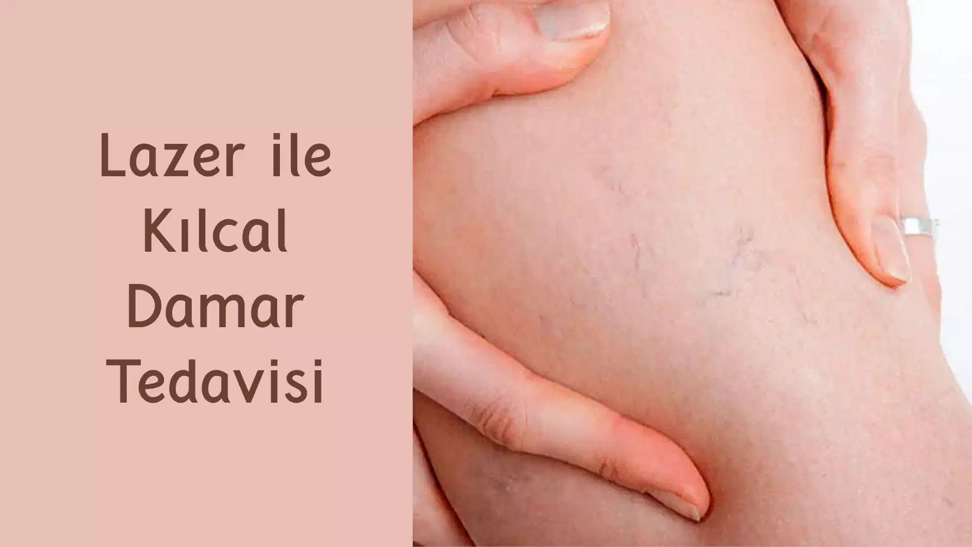 ankara lazer ile kilcal damar tedavisi