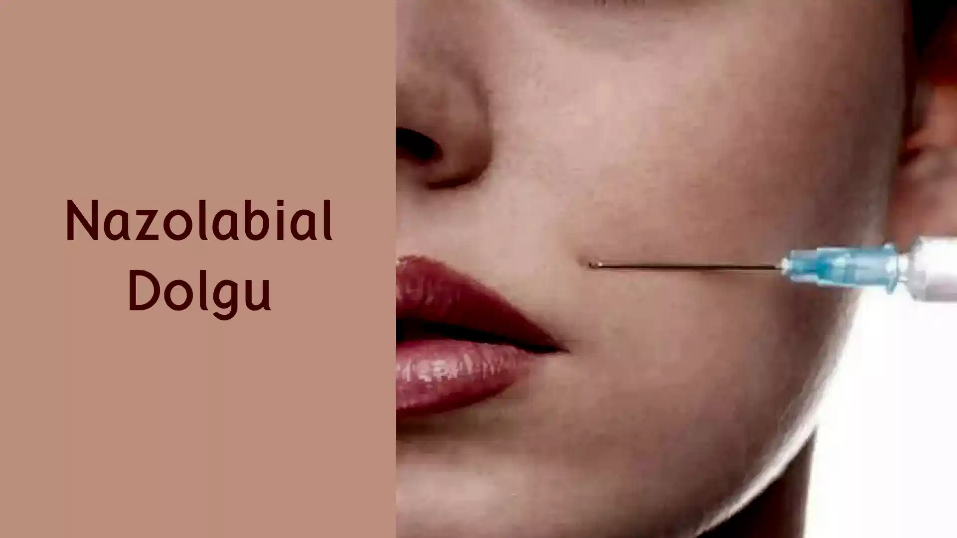 ankara nazolabial dolgu